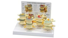 GPI Anatomicals  4 Stage Vertebrae Model