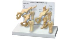 GPI Anatomicals  4-Stage Arthritic Hip Model