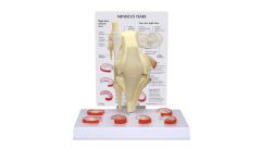GPI Anatomicals  Meniscus 6 Tears Model
