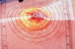Disposable Wound Measuring Guides by Alimed ALI70831