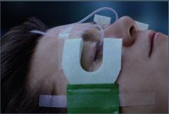 Medi-Duct Fluid Management System for Use with for Use with Morgan medi-Flow Lenses