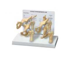 GPI Anatomicals  4-Stage Arthritic Hip Model