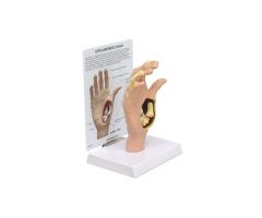GPI Anatomicals  Osteoarthritis (OA) Hand Model